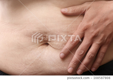 Close up of mother womans belly showing stretch mark loose lower abdomen skin she fat after pregnancy baby birth, studio isolated on white background, Healthy belly overweight excess body concept Close up of mother womans belly showing stretch mark loose lower abdomen skin she fat after pregnancy baby birth, studio isolated on white background, Healthy belly overweight excess body concept 108587808