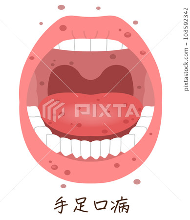 Tongue, teeth, hand, foot and mouth disease illustration, illustration 108592342