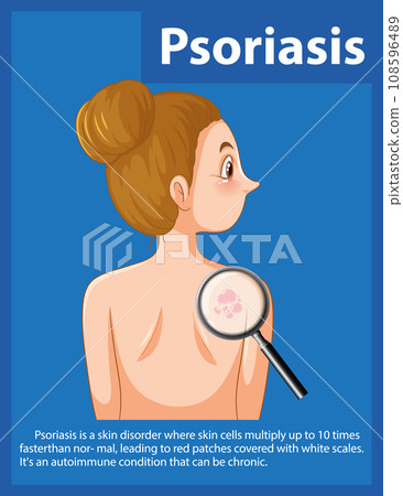 Women with Psoriasis: Understanding the Skin Disease Women with Psoriasis: Understanding the Skin Disease 108596489