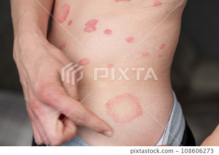 Psoriasis Vulgaris, skin patches are typically red, itchy, and scaly. Papules of chronic psoriasis vulgaris on male hand, back and body. Genetic immune disease. Detail of psoriatic skin disease Psoriasis Vulgaris, skin patches are typically red, itchy, and scaly. Papules of chronic psoriasis vulgaris on male hand, back and body. Genetic immune disease. Detail of psoriatic skin disease 108606273