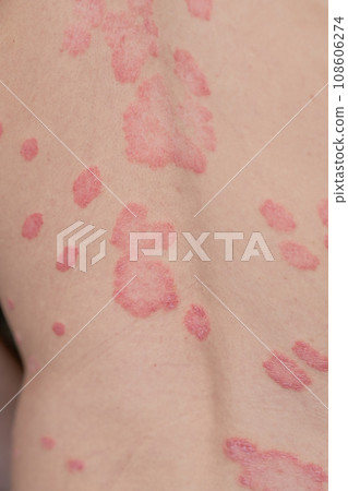 Psoriasis Vulgaris, skin patches are typically red, itchy, and scaly. Papules of chronic psoriasis vulgaris on male hand, back and body. Genetic immune disease. Detail of psoriatic skin disease Psoriasis Vulgaris, skin patches are typically red, itchy, and scaly. Papules of chronic psoriasis vulgaris on male hand, back and body. Genetic immune disease. Detail of psoriatic skin disease 108606274