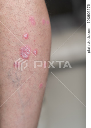 Psoriasis Vulgaris, skin patches are typically red, itchy, and scaly. Papules of chronic psoriasis vulgaris on male hand, back and body. Genetic immune disease. Detail of psoriatic skin disease Psoriasis Vulgaris, skin patches are typically red, itchy, and scaly. Papules of chronic psoriasis vulgaris on male hand, back and body. Genetic immune disease. Detail of psoriatic skin disease 108606276