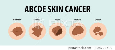 Illustrated Guide to Five Types of Skin Cancer 108722309