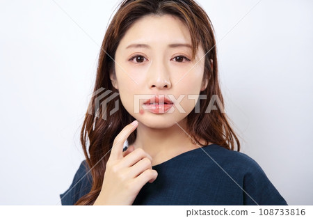 Image of a woman suffering from acne 108733816
