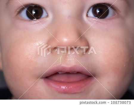Bacterial diseases in the nose. Yellow snot from the nose of a little boy. Colds and infectious diseases, allergies. Close-up 108738073