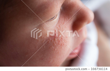 Allergic pimples in a newborn on the face. Pathogenesis, acne of newborns. 108738114