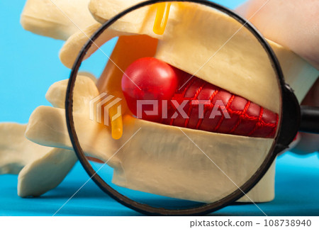 Inflamed red herniated disc of the spine under a magnifying glass. Concept for the treatment of spinal diseases, osteochondrosis and kyphosis, close-up 108738940
