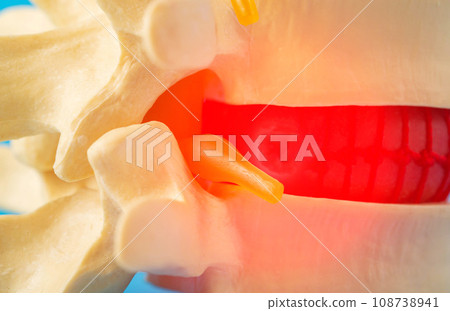 Red inflamed spine with a compressed nerve root, close-up. Neuralgia and radiculitis in diseases of the spine. Back pain, close-up 108738941