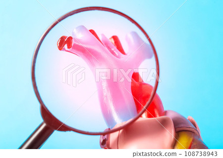 Inflamed coronary arteries of the heart under a magnifying glass on a blue background. Concept of atherosclerosis of the coronary arteries of the heart, risk of heart attack and angina, close-up Inflamed coronary arteries of the heart under a magnifying glass on a blue background. Concept of atherosclerosis of the coronary arteries of the heart, risk of heart attack and angina, close-up 108738943