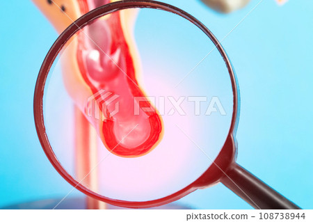 Medical mockup of an inflamed female reproductive system under a magnifying glass on a blue background. Concept of vaginal infections candidiasis and vaginitis, close-up 108738944