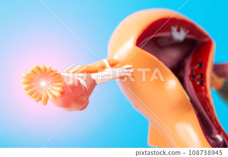 Inflamed, diseased female ovary on a medical mock-up. The concept of diseases and pain in the ovaries of a girl during menstruation. Infection and contagion in gynecology, close-up 108738945