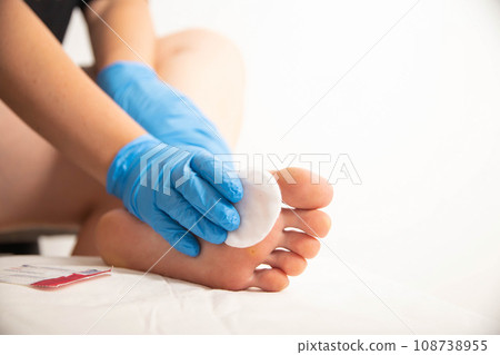 Treatment of a callus on the foot with a special solution after surgery to remove the callus and wart. Copy space for text 108738955