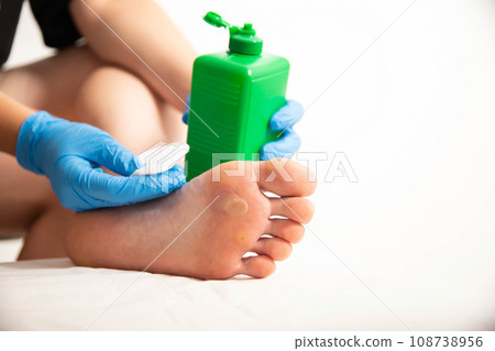 The doctor uses a special liquid to burn a removed callus on the foot. Surgical removal of calluses and warts, close-up The doctor uses a special liquid to burn a removed callus on the foot. Surgical removal of calluses and warts, close-up 108738956