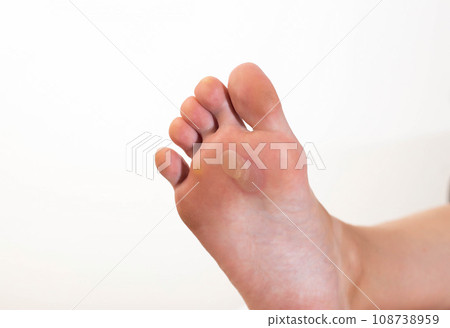A person's foot has a large callus on its foot due to rubbing from uncomfortable shoes. Rod wart on the sole of the foot, close-up. Copy space for text A person's foot has a large callus on its foot due to rubbing from uncomfortable shoes. Rod wart on the sole of the foot, close-up. Copy space for text 108738959