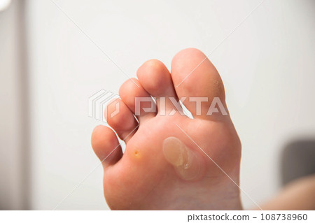 Human foot with a large callus and chicken jowl wart on a white background, close-up. Human papilloma virus Human foot with a large callus and chicken jowl wart on a white background, close-up. Human papilloma virus 108738960