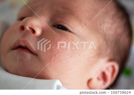 Pimples on the face of a newborn. Baby's adaptation to the environment, close-up Pimples on the face of a newborn. Baby's adaptation to the environment, close-up 108739024