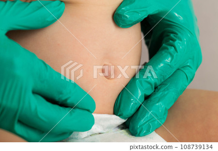 Doctor's hands in green medical gloves examine an umbilical hernia in a child, close-up. Doctor's hands in green medical gloves examine an umbilical hernia in a child, close-up. 108739134