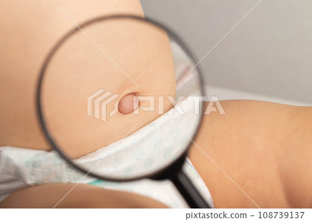 An umbilical hernia in a child on the stomach through a magnifying glass. Treatment of dilated umbilical ring, medical. Close-up 108739137