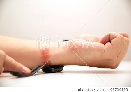 Redness and allergies on a person s wrist from wearing a fitness bracelet with a silicone strap. Contact dermatitis, close-up. Copy space for text 108739183