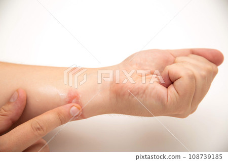 A man rubs his finger over the redness and irritation on the skin of his wrist caused by a silicone watch strap. Allergies and dermatitis. Copy space for text 108739185