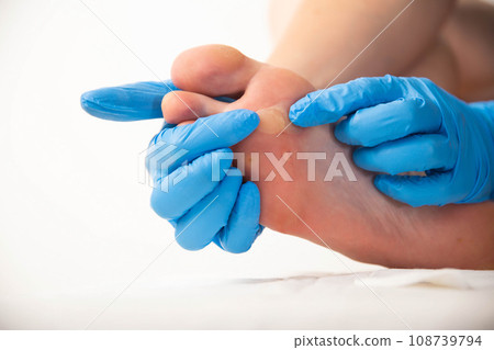 Doctor squeezing and removing a callus on the foot, close-up. Dermatoscopy Doctor squeezing and removing a callus on the foot, close-up. Dermatoscopy 108739794