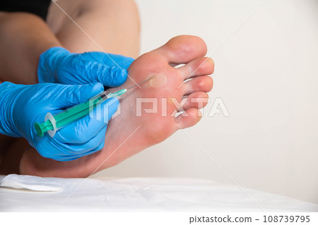 surgery to pierce and remove fluid from a callus on the foot, close-up 108739795