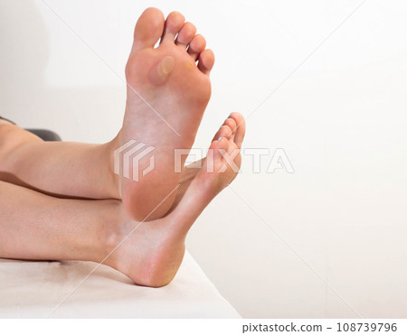 A person's foot has a large callus on its foot due to rubbing from uncomfortable shoes. Rod wart on the sole of the foot, close-up. Copy space for text A person's foot has a large callus on its foot due to rubbing from uncomfortable shoes. Rod wart on the sole of the foot, close-up. Copy space for text 108739796