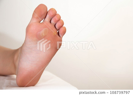 A person's foot has a large callus on its foot due to rubbing from uncomfortable shoes. Rod wart on the sole of the foot, close-up. Copy space for text A person's foot has a large callus on its foot due to rubbing from uncomfortable shoes. Rod wart on the sole of the foot, close-up. Copy space for text 108739797