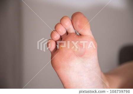 A person's foot has a large callus on its foot due to rubbing from uncomfortable shoes. Rod wart on the sole of the foot, close-up A person's foot has a large callus on its foot due to rubbing from uncomfortable shoes. Rod wart on the sole of the foot, close-up 108739798