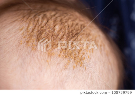 Milk crusts on the head of a newborn child, gneiss. The formation of yellow-golden scales on the head of an infant, close-up 108739799