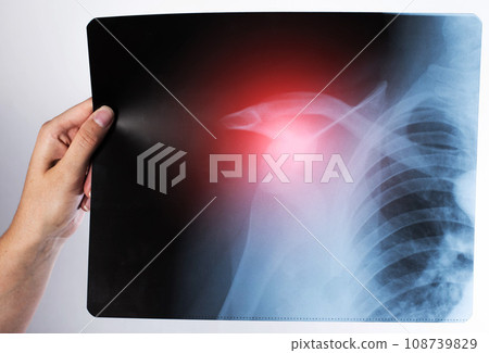The doctor holds in his hand an x-ray of a dislocated shoulder joint and a fracture of the humerus. Inflammation and synovitis at the site of injury, close-up The doctor holds in his hand an x-ray of a dislocated shoulder joint and a fracture of the humerus. Inflammation and synovitis at the site of injury, close-up 108739829