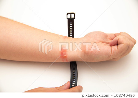Redness and allergies on a person s wrist from wearing a fitness bracelet with a silicone strap. Contact dermatitis, close-up Redness and allergies on a person s wrist from wearing a fitness bracelet with a silicone strap. Contact dermatitis, close-up 108740486