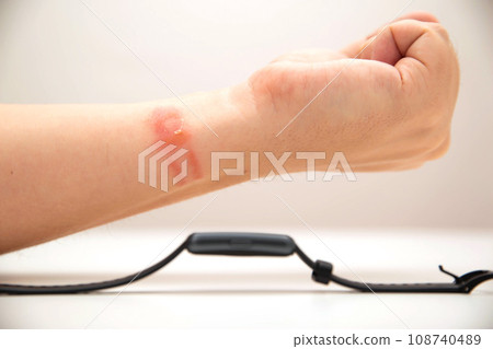 Redness and allergies on a person s wrist from wearing a fitness bracelet with a silicone strap. Contact dermatitis, close-up 108740489