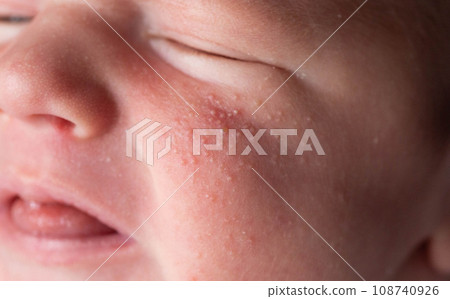 Allergic pimples in a newborn on the face. Pathogenesis, acne of newborns. 108740926