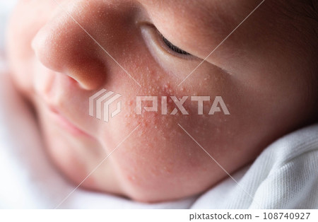 Allergic pimples in a newborn on the face. Pathogenesis, acne of newborns. Allergic pimples in a newborn on the face. Pathogenesis, acne of newborns. 108740927