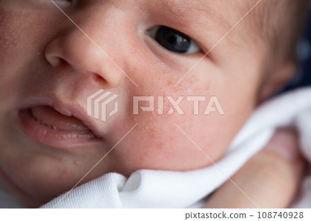 Allergic pimples in a newborn on the face. Pathogenesis, acne of newborns. 108740928