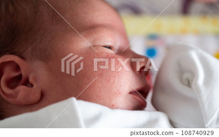 Allergic pimples in a newborn on the face. Pathogenesis, acne of newborns. Allergic pimples in a newborn on the face. Pathogenesis, acne of newborns. 108740929
