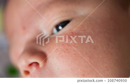 Rash on the face of a newborn baby. The process of formation of the hormonal system, close-up 108740930