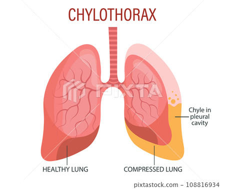 Chylothorax, lung diseases. Healthcare. Medical infographic banner, illustration, vector Chylothorax, lung diseases. Healthcare. Medical infographic banner, illustration, vector 108816934