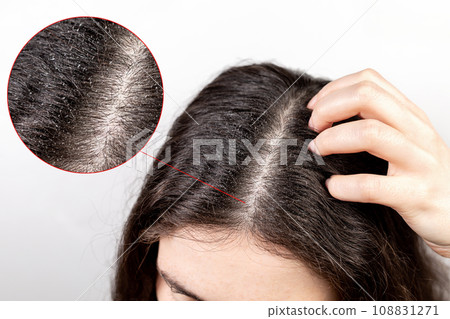 The woman scratches her head with her hand, showing a parting of dark hair with dandruff.Close up.The view from the top. White background.Zoomed parting of hair.The concept of dandruff and pediculosis 108831271