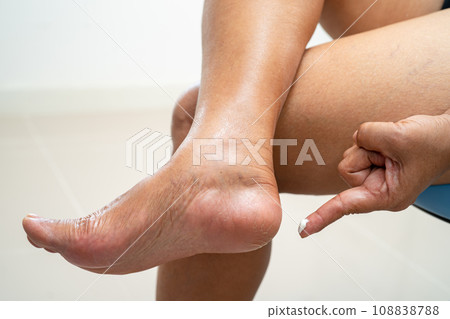 Asian woman care feet with cracked and dry heel skin cream at home. 108838788