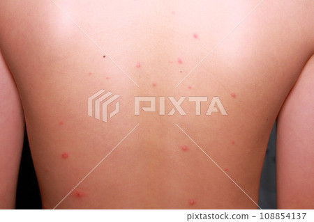 Chickenpox (on the back of a child with a rash caused by chickenpox) Chickenpox (on the back of a child with a rash caused by chickenpox) 108854137