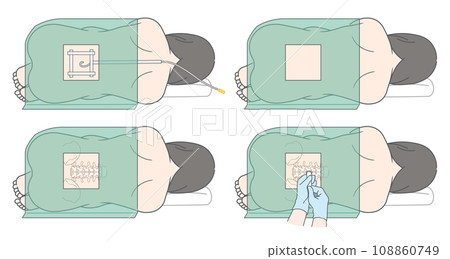 硬脊膜外麻醉、蜘蛛網膜下腔麻醉及無痛分娩圖示 108860749