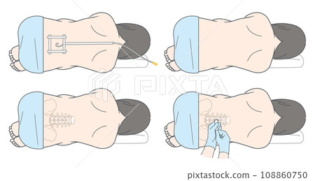 硬脊膜外麻醉、蜘蛛網膜下腔麻醉及無痛分娩圖示 硬脊膜外麻醉、蜘蛛網膜下腔麻醉及無痛分娩圖示 108860750