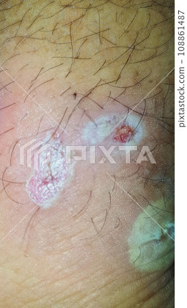 Diabetes mellitus wound, blisters, boils, infections, rash of the foot. Infected wound, treatment of a diabetic patient's leg infection. skin itchy, skin disease, skin problems 108861487