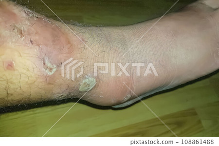 Diabetes mellitus wound, blisters, boils, infections, rash of the foot. Infected wound, treatment of a diabetic patient's leg infection. skin itchy, skin disease, skin problems 108861488