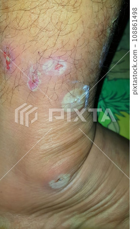 Diabetes mellitus wound, blisters, boils, infections, rash of the foot. Infected wound, treatment of a diabetic patient's leg infection. skin itchy, skin disease, skin problems 108861498