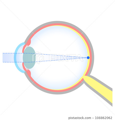 Illustration of normal eyeball (emmetropia) Illustration of normal eyeball (emmetropia) 108862062