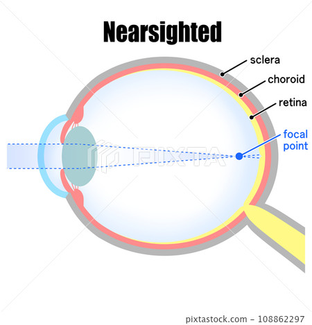 Illustration of an eyeball with axial myopia Illustration of an eyeball with axial myopia 108862297