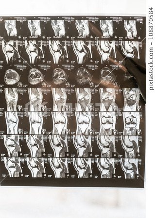 Knee joint x-ray or MRI. Doctor pointed on area of knee joint, where pathology or problem is detected, such fracture, destruction of joint, osteoarthritis, magnetic resonance enterography. Knee joint x-ray or MRI. Doctor pointed on area of knee joint, where pathology or problem is detected, such fracture, destruction of joint, osteoarthritis, magnetic resonance enterography. 108870584
